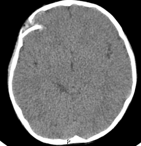 Depressed open skull fracture